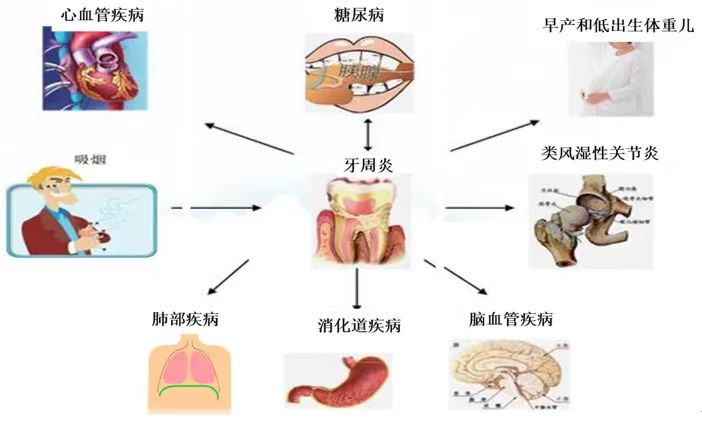 牙周炎反复发作，可能与糖尿病有关